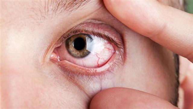 6 أسباب صادمة لألم العين المفاجئ