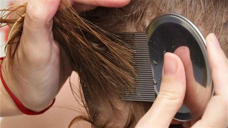 طرق منزلية للتخلص والعلاج من القمل في الشعر