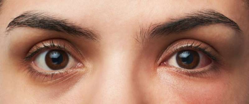 حلول منزلية لعلاج التهابات العين