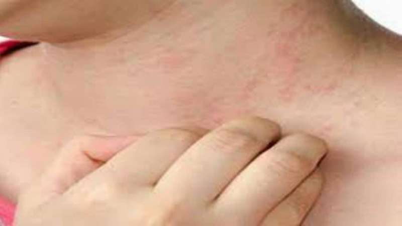 علاج حساسية الجلد في فصل الصيف