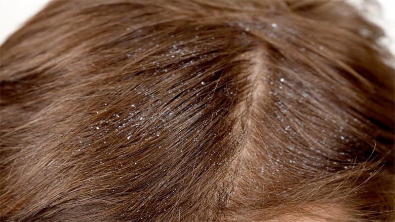 علاج منزلي لقشرة الشعر