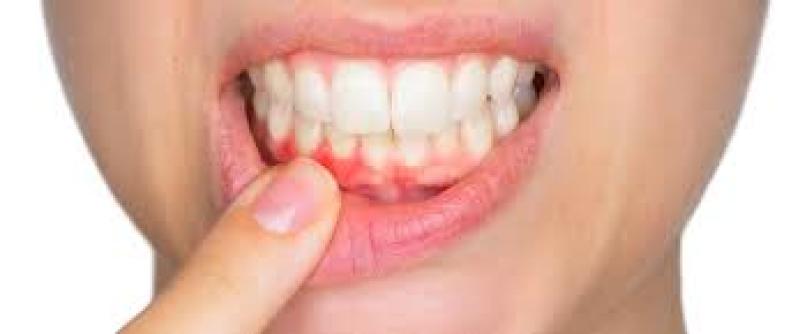 تناول الأطعمة الحمضية بكثرة يسبب تآكل في الأسنان