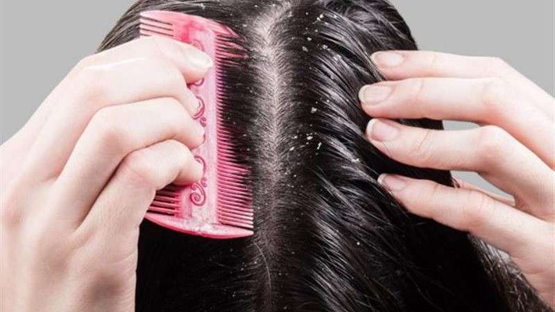 هيئة الدواء: الذكور أكثر عرضة للإصابة بقشرة الشعر من الإناث