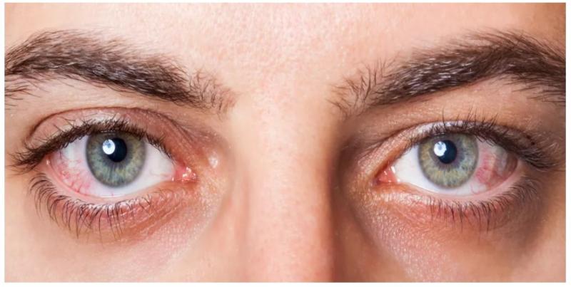 «هيئة الدواء» تقدم نصائح لتجنب الإصابة بجفاف العين