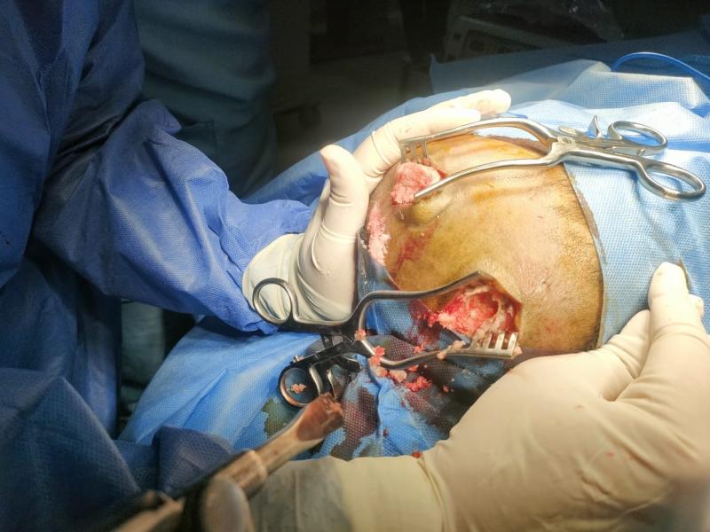 صحة الشرقية: إجراء جراحة لتفريغ نزيف مخي لإنقاذ حياة سيدة بمستشفى السعديين المركزي