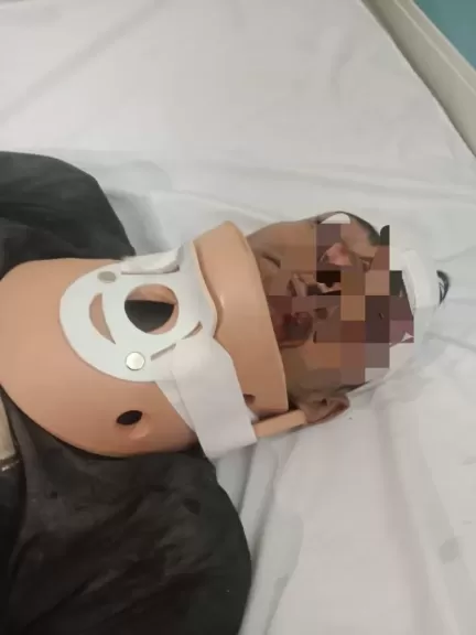 للمرة الأولى بـ” صحة الدقهلية”.. نجاح جراحة دقيقة لإصلاح كسر بالرقبة في تمى الأمديد”