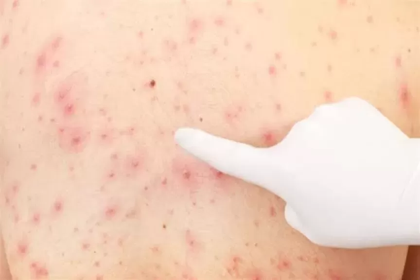 كيف تتخلصين من حبوب الظهر؟.. دليلك العملي لبشرة صحية ونقية
