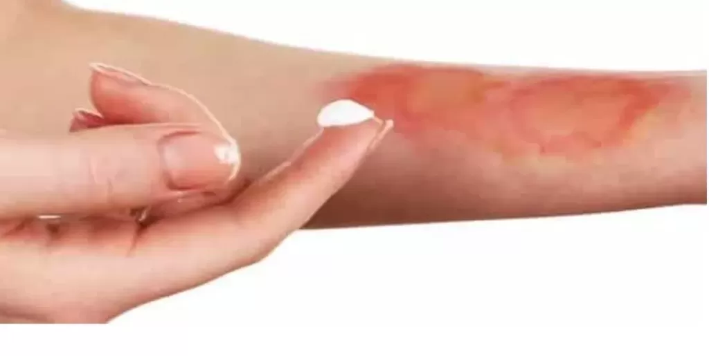 كيفية التعامل مع الحروق الجلدية بالمنزل والأخطاء الشائعة في علاجها