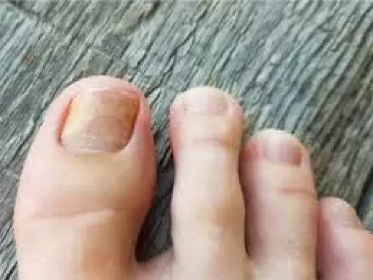 لماذا تصفرّ أظافر القدم؟.. الأسباب والعلاجات
