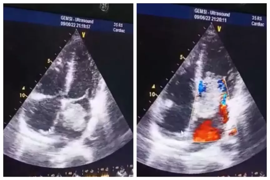 نجاح فريق طبي بمستشفى القلب بجامعة أسيوط في إجراء جراحة قلب مفتوح معقدة لمريض يعاني من ورم بالقلب