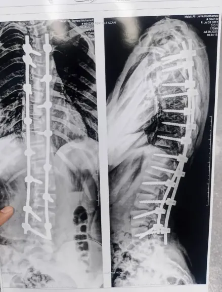 نجاح جراحة دقيقة لتقويم اعوجاج عمود فقري لطفلة في مجمع طنطا الطبي