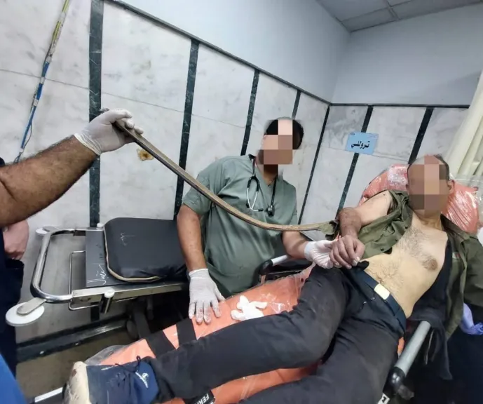 إنقاذ مريض من بتر ذراعه بعد جراحة دقيقة ببنها