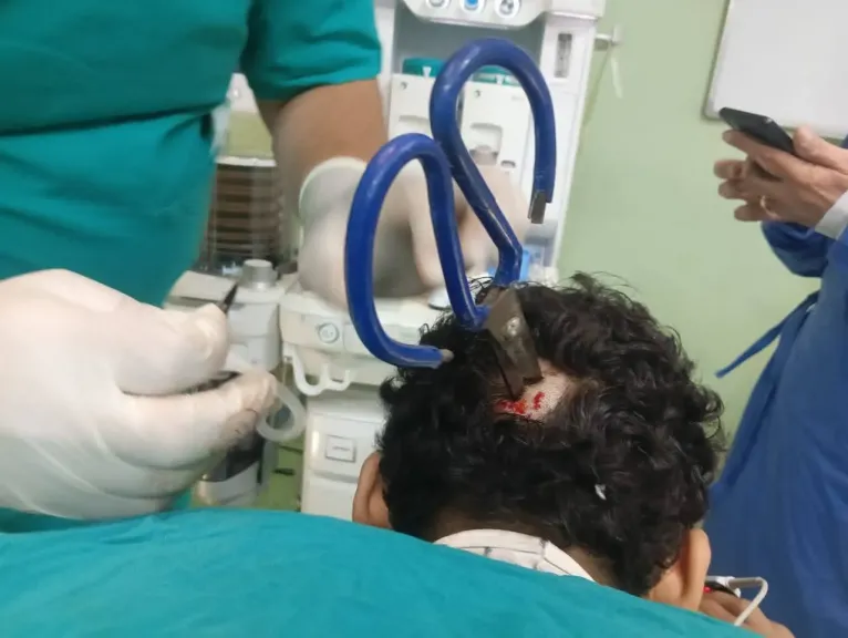 معجزة طبية في بنها.. استخراج مقص حديدي من جمجمة مريض وإنقاذ حياته