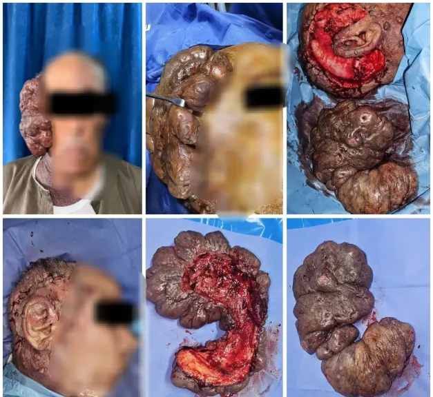 فريق طبي بقسم جراحة التجميل بالمستشفى الرئيسي بجامعة أسيوط ينجح في إجراء جراحة نادرة لاستئصال ورم ضخم بالوجه