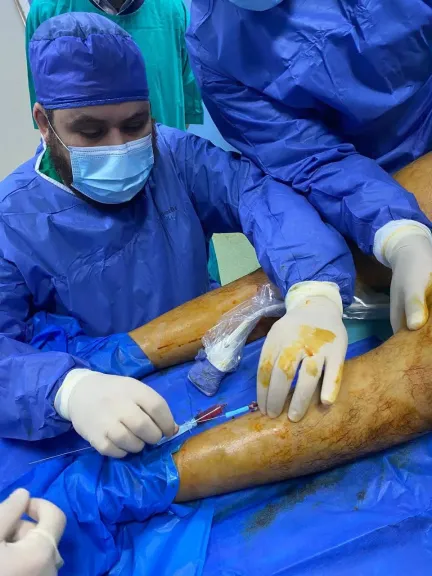 إنجاز طبي ب”مبرة المحلة”.. نجاح أول جراحة بالتردد الحراري لعلاج دوالي ساق نازفة
