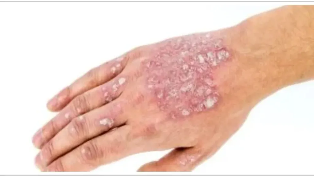 في يومها العالمي.. أطعمة ممنوعة لمرضي الصدفية في يومها العالمي.. أطعمة ممنوعة لمرضي الصدفية