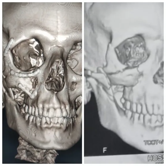 نجاح جراحة دقيقة لإصلاح كسر معقّد بمنتصف الوجه في مستشفى شربين