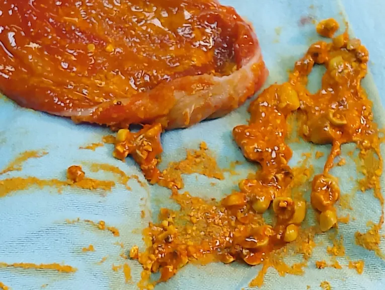 نجاح أول عملية لاستخراج حصوات بالقناة المرارية باستخدام ERCP داخل مستشفيات صحة الدقهلية