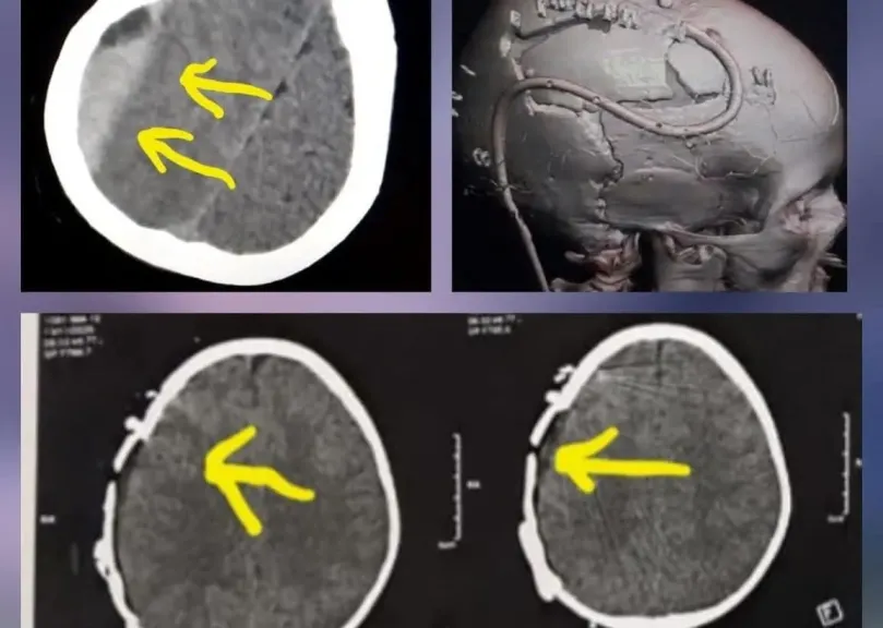 بين الحياة والموت.. فريق مستشفى كفر شكر التخصصي ينقذ طفلًا من نزيف قاتل بالمخ