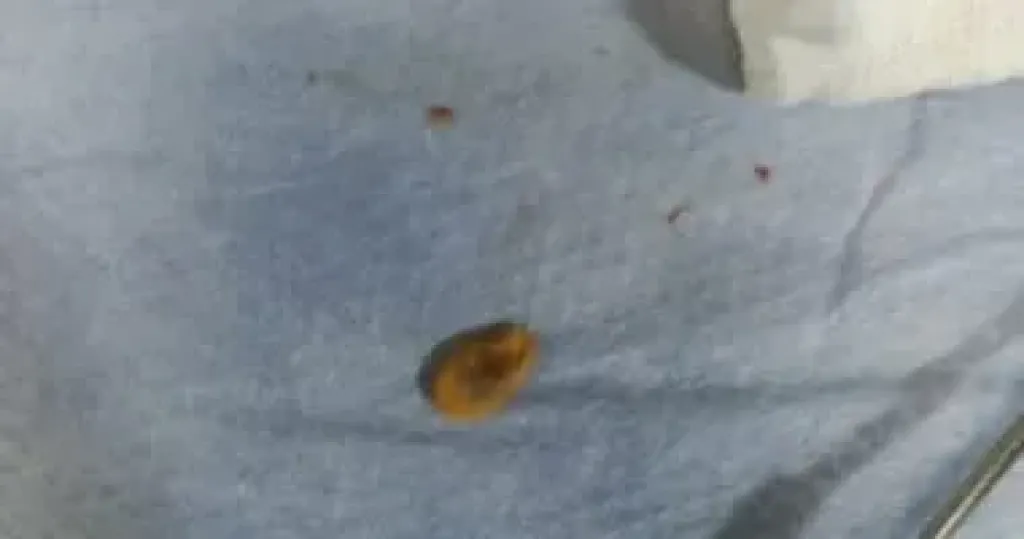 حبة لب كادت تقتل طفلًا.. معجزة طبية تنقذ حياة رضيع ببنها