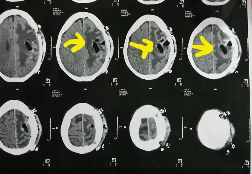 تدخل عاجل وجراحة معقدة.. إنقاذ حياة سيدة سبعينية من ورم بالمخ بالقليوبية