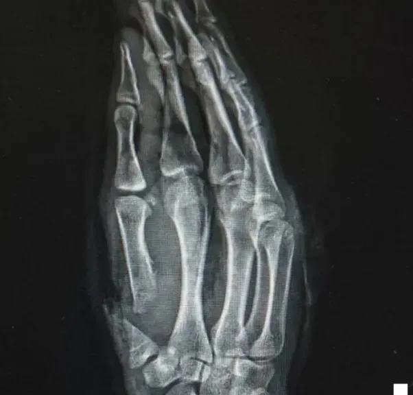 بعد جراحة استمرت 6 ساعات.. مستشفى سوهاج الجامعي تنجح في إنقاذ شاب أُصيب ببتر كامل في إصبع الإبهام