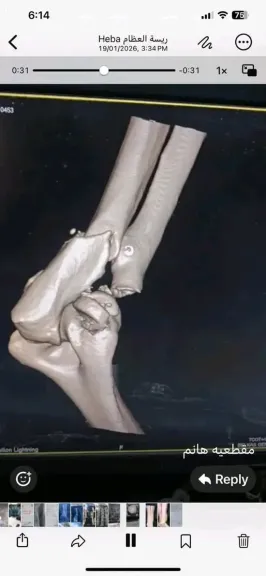 نجاح أول عملية تركيب مفصل صناعي  بمستشفى بلقاس العام