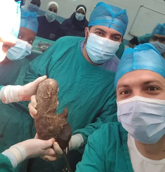فريق طبي بالاسكندرية يستصال جسم غريب يستحوذ علي ٩٠%من حجم المعدة لفتاة عشرينية