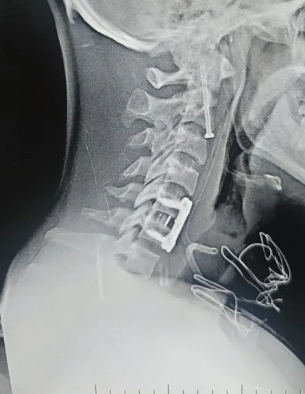 أطباء بنها يتحدون الخطر.. جراحة دقيقة تنقذ مريضًا من إصابة قاتلة بالفقرات العنقية