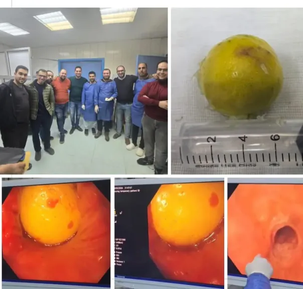 نجاح طبي بمركز الكبد بكفر الشيخ في إنقاذ شاب ابتلع جسمًا غريياً