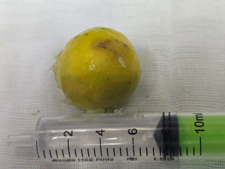 إنقاذ شاب من ذوي الهمم بعد ابتلاع جسم غريب