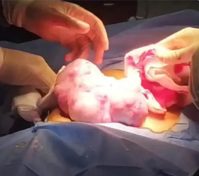 إنجاز طبي بمستشفى سرطان الأطفال بجامعة طنطا.. استئصال ورم يزن 2 كجم من طفلة في جراحة دقيقة