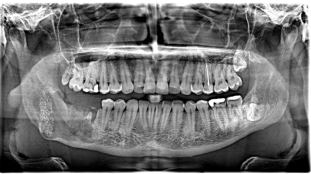 نجاح علاج جراحي مرحلي لحالة كيس عظمي بالفك السفلي بمستشفى شربين المركزي