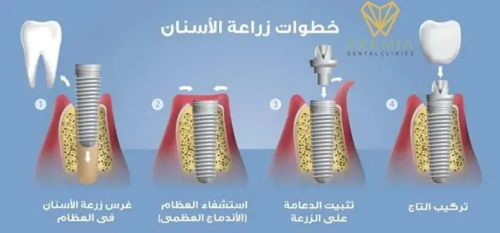 نتائج زراعة الأسنان وتكلفتها: متى تستحق هذا الاستثمار؟