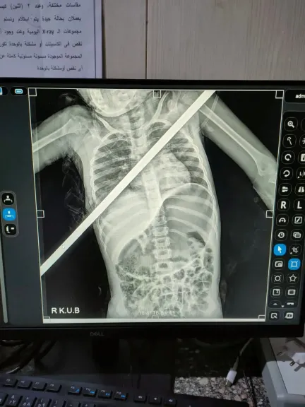 اختراق كامل للصدر دون إصابة القلب.. قصة إنقاذ طفلة في عملية جراحية نادرة ببنها