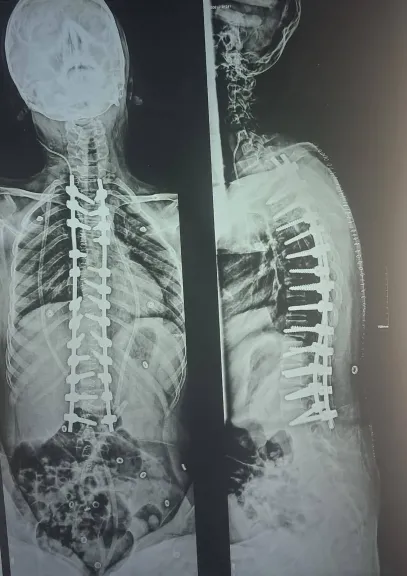 مستشفى جامعة الأزهر بأسيوط ينهي معاناة طفلة من اعوجاج بالعمود الفقري