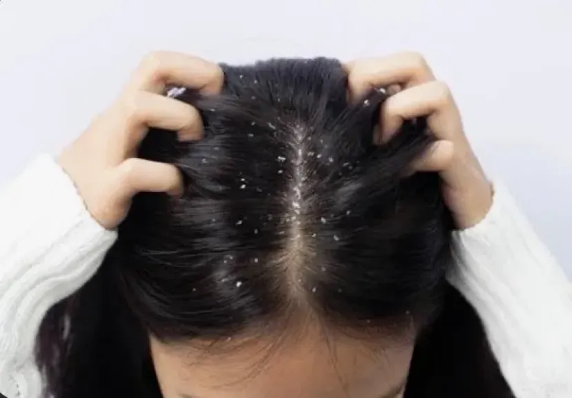 3 طرق فعالة للتخلص من قشرة الرأس واستعادة صحة الشعر