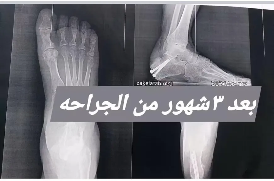 منها تصحيح تشوه كاحل.. مستشفى قويسنا المركزي يحقق نجاحين في جراحات العظام خلال أيام
